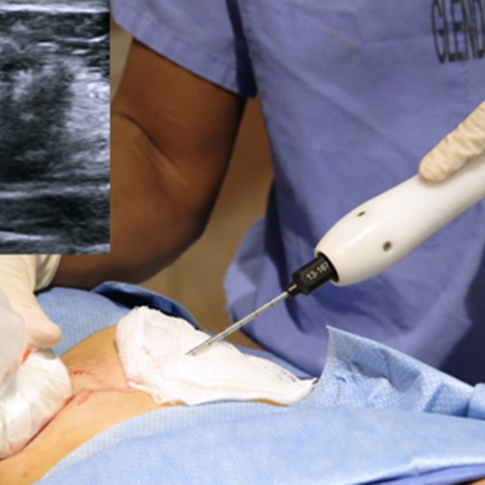 Ice Cure breast cancer procedure Alabama News