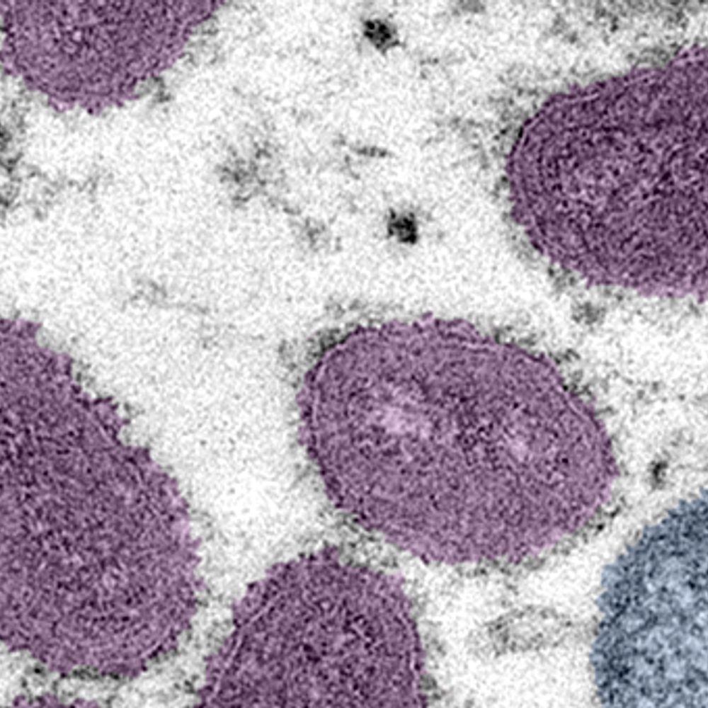 Monkeypox virus Alabama News