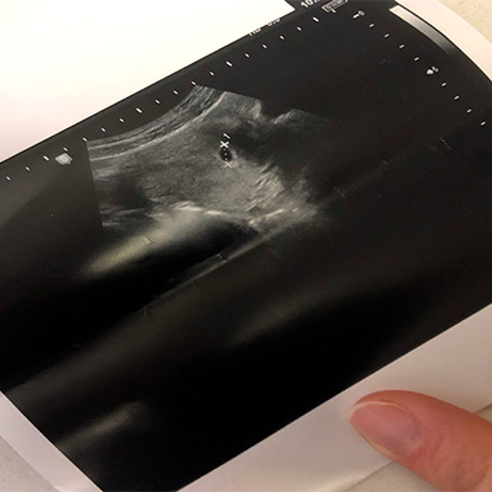 ULTRASOUND BABY ABORTION BIRTH Alabama News