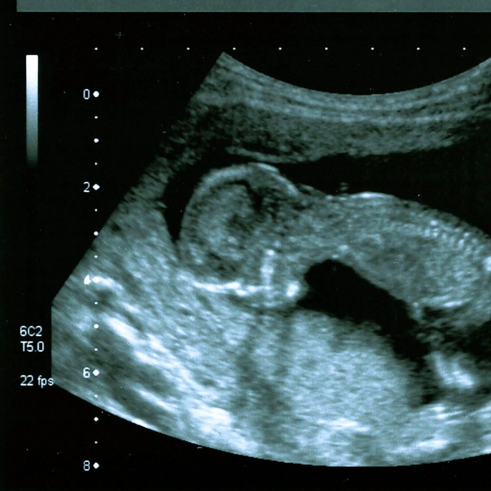 ultrasound Alabama News