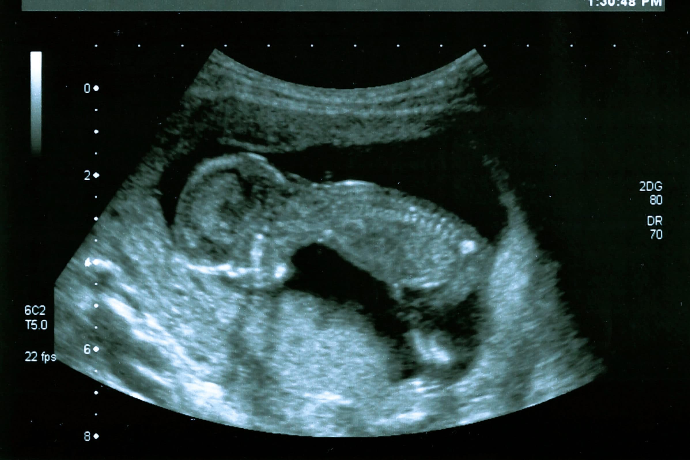 Legislation filed to add rape and incest exception to Alabama’s